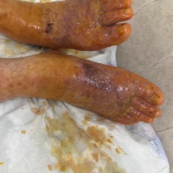 Artcure Yan Etkili Bandın Mağduru