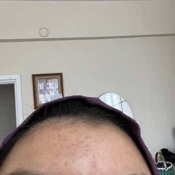 The Purest Solutions Purest Gylcolic Acid Ve Hydration Booster Nemlendirici Akne Yaptı