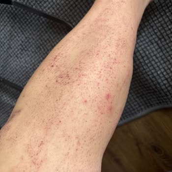 Veet Tüy Dökücü Yanık