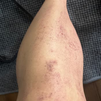 Veet Tüy Dökücü Yanık