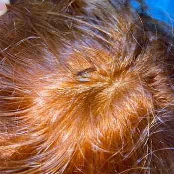 Palette Kafa Derisi Ve Saç Yanma