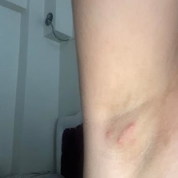 Rexona Koltuk Altı Yanığı Ağrılı Beze Şişliği Ve Kaşıntılı Sivilce Oluşumu