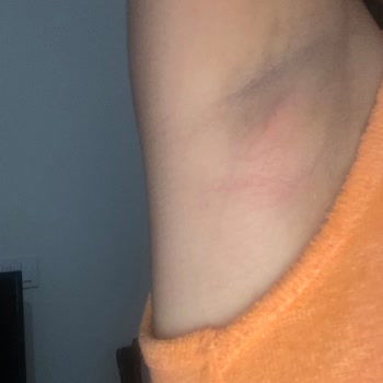 Rexona Koltuk Altı Yanığı Ağrılı Beze Şişliği Ve Kaşıntılı Sivilce Oluşumu