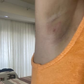 Rexona Koltuk Altı Yanığı Ağrılı Beze Şişliği Ve Kaşıntılı Sivilce Oluşumu