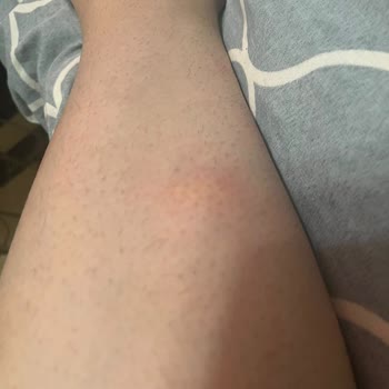 Bingo Matik Leke Tanıma + Anti-aging