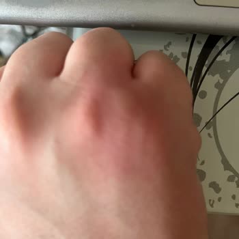 Bingo Matik Leke Tanıma + Anti-aging