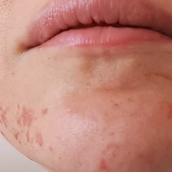 Van Neslim Güngen Güzellik Salonu Ağda Yanığı