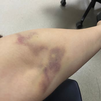 Özel Bilgi Hastanesi (Ankara) Tecrübesiz Ve İlgisiz Hemşireler