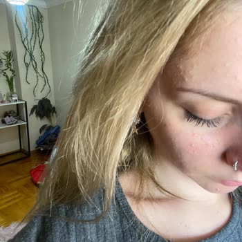 Loreal Paris Ciltte Sivilce Alerji Kızarıklık