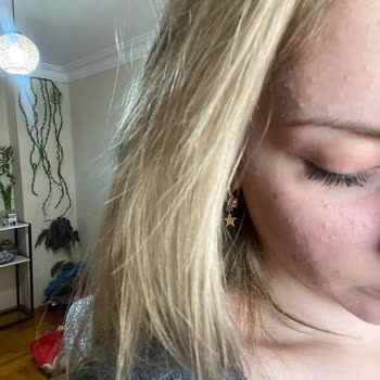 Loreal Paris Ciltte Sivilce Alerji Kızarıklık