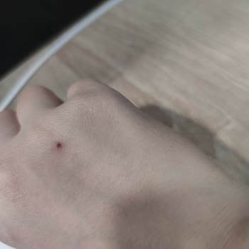 Aleyna Gülten Beauty Lazer Epilasyon Sonrası Benimde Soyulma Meydana Geldi