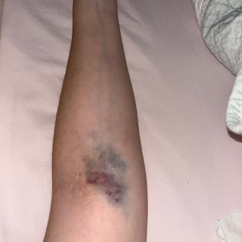 Liv Hospital Liv Ankara Hemşire Mağduriyeti