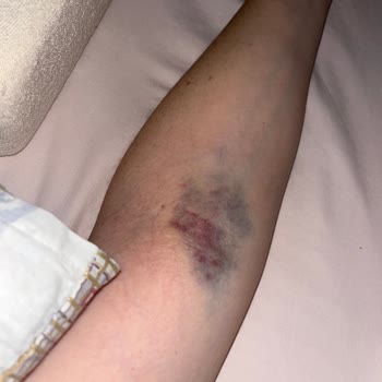 Liv Hospital Liv Ankara Hemşire Mağduriyeti