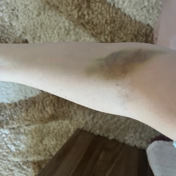 Liv Hospital Liv Ankara Hemşire Mağduriyeti