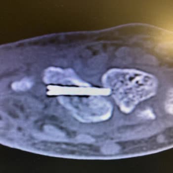 Kolan Hospital Yanlış Ameliyat Ve Tedavi