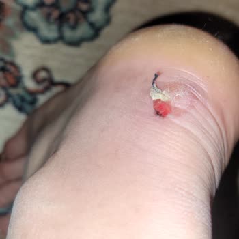 Torex FLO Ayakkabı Vurması Ve Ret Kararı