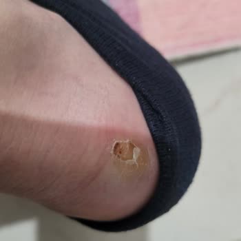 Torex FLO Ayakkabı Vurması Ve Ret Kararı