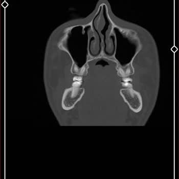 Yaşam Hastanesi (Kırıkkale) Yaşam Hastanesi Burun Ameliyatı
