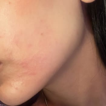 Nivea Alerji Kaşıntı Yanma