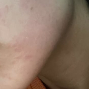 Nivea Alerji Kaşıntı Yanma