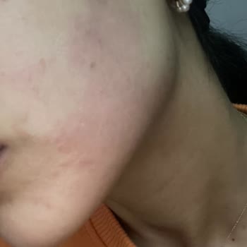 Nivea Alerji Kaşıntı Yanma