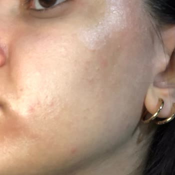 The Purest Solutions Oil Control Toneri Yüzümde Sivilce+Kızarma Yaptı