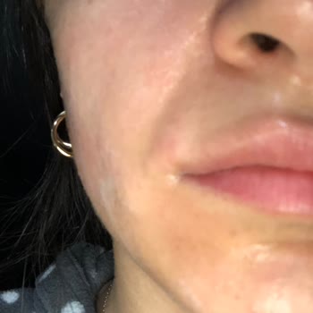 The Purest Solutions Oil Control Toneri Yüzümde Sivilce+Kızarma Yaptı