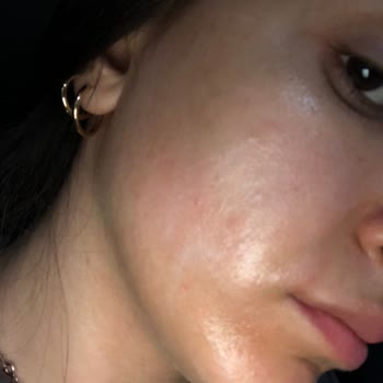 The Purest Solutions Oil Control Toneri Yüzümde Sivilce+Kızarma Yaptı