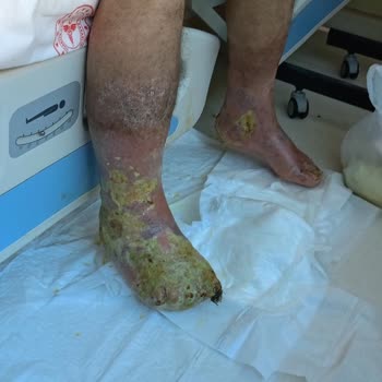 Göztepe Prof. Dr. Süleyman Yalçın Şehir Hastanesi Büyük Yaraya Hemşireler Pansuman Yapmıyor