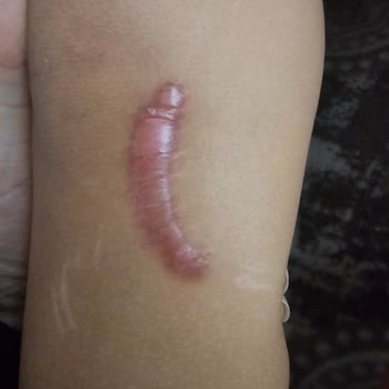 Adana Şehir Hastanesi Acil Serviste Doktorum Yanlış Dikişi