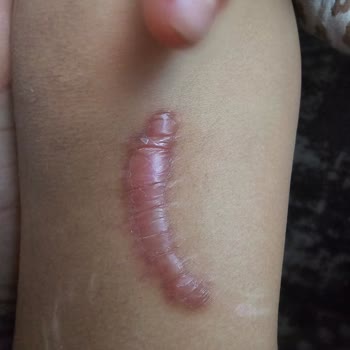 Adana Şehir Hastanesi Acil Serviste Doktorum Yanlış Dikişi
