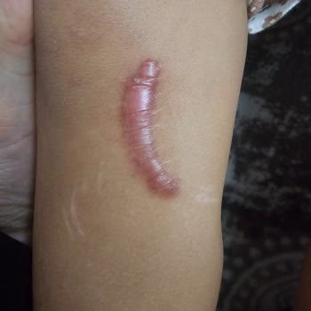 Adana Şehir Hastanesi Acil Serviste Doktorum Yanlış Dikişi