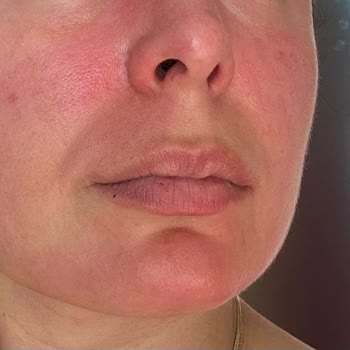 Harrem Concept Gül Mayası Yüzümü Yaktı Mahvetti