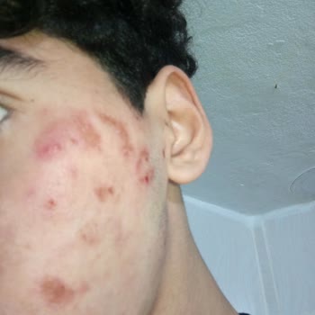 Dove Sivilce Ve Akne