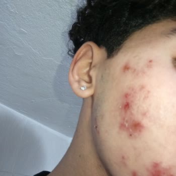 Dove Sivilce Ve Akne