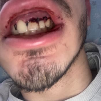 Medipol Sağlık Grubu Yaşanan Diş Tedavi Süreci Hüsranı