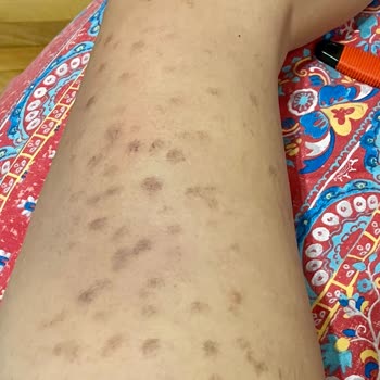 As Estetik Lazerle Bacağımı Yaktı