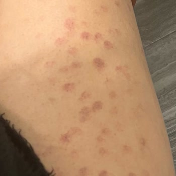 As Estetik Lazerle Bacağımı Yaktı