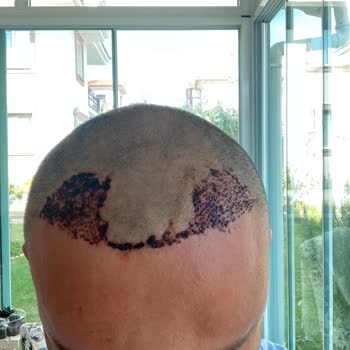 Alfa Tıp Merkezi Saç Ekimi Hüsranı