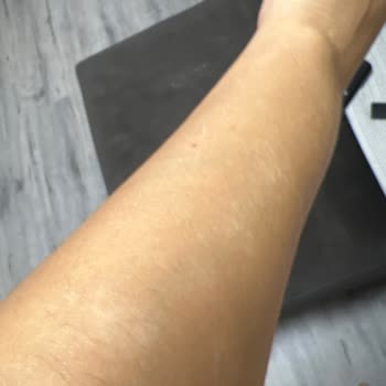 Novar Poliklinik Atakent Şubede Lazer Yanığı