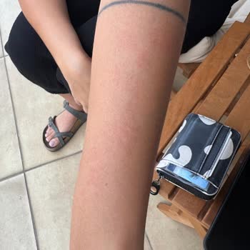 Novar Poliklinik Atakent Şubede Lazer Yanığı