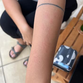 Novar Poliklinik Atakent Şubede Lazer Yanığı