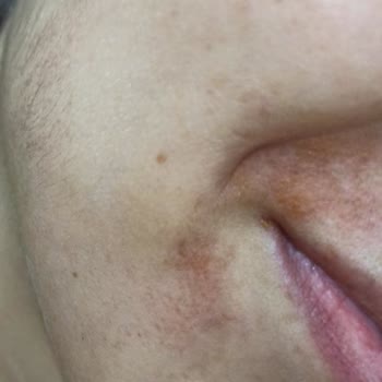 Deniz Damla Dermapenle Yüzümü Yaktılar