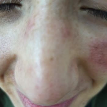 Deniz Damla Dermapenle Yüzümü Yaktılar