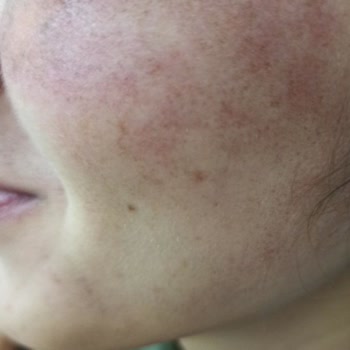 Deniz Damla Dermapenle Yüzümü Yaktılar