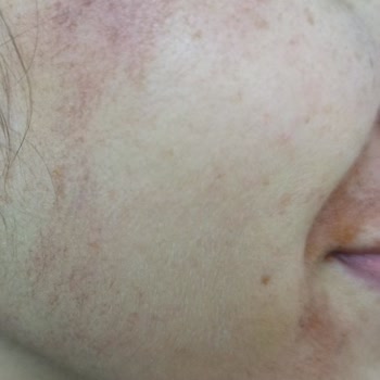 Deniz Damla Dermapenle Yüzümü Yaktılar