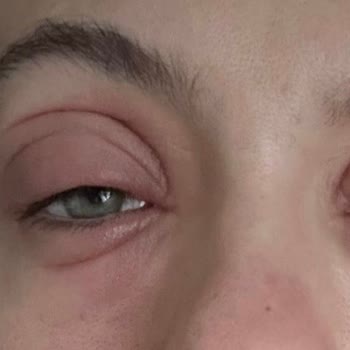 Watsons Duaderm Lipozom Göz Çevresi Serumu Alerjik Reaksiyon