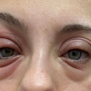 Watsons Duaderm Lipozom Göz Çevresi Serumu Alerjik Reaksiyon