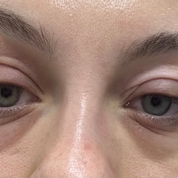 Watsons Duaderm Lipozom Göz Çevresi Serumu Alerjik Reaksiyon