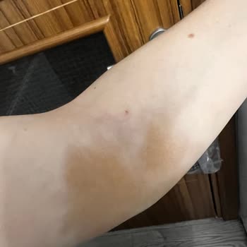 Medical Park Hastanesi Serum Takılma İşleminin Yapılamaması